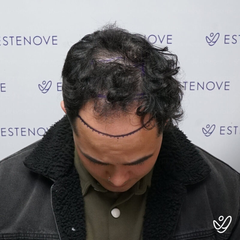 FUE 4500 Grafts Before Hair Transplant Photo FUE 4500 Grafts Before Hair Transplant Photo