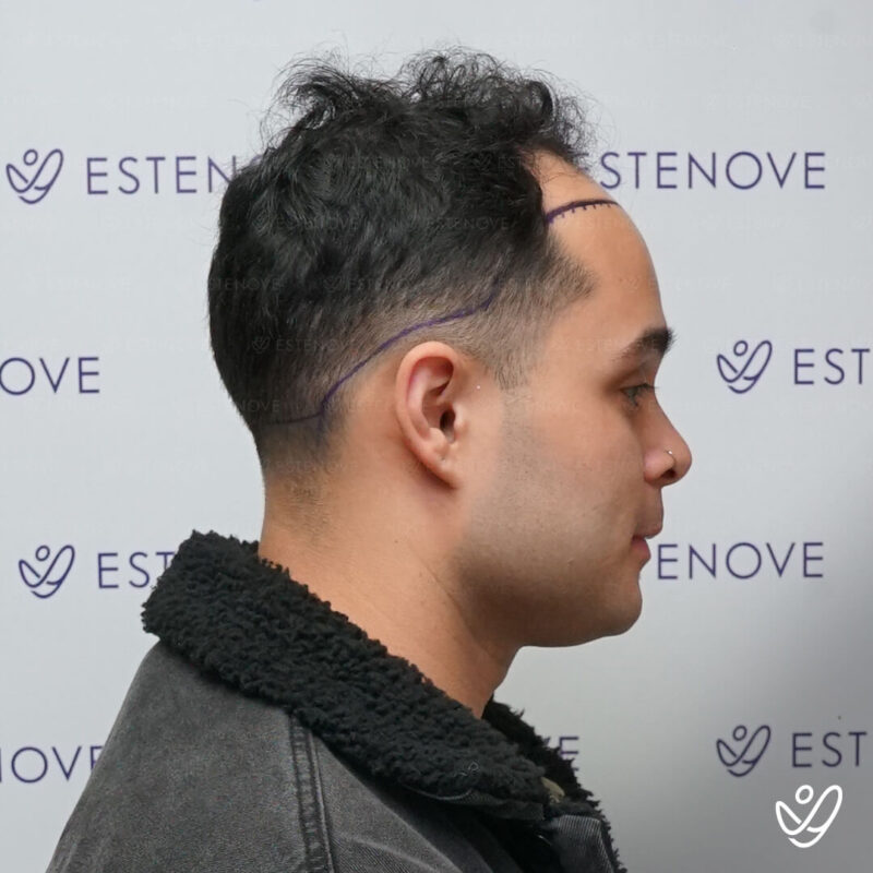 FUE 4500 Grafts Before Hair Transplant Photo FUE 4500 Grafts Before Hair Transplant Photo