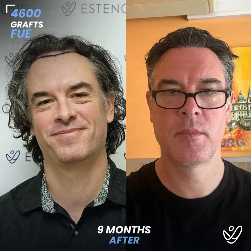 Mark_Pollard1 (1) FUE 4600 Grafts Hair Transplant 9 Months Before&After