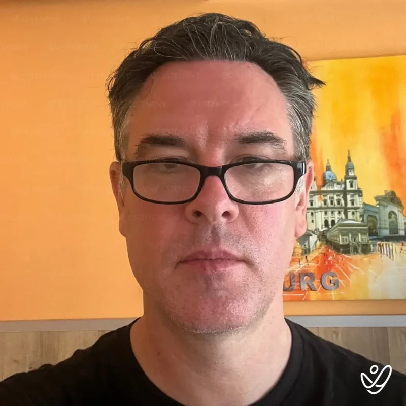 Mark_Pollard7 (1) Mark_Pollard after hair transplantation from front