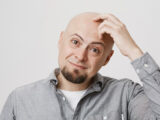 Does Hair Transplant Leave Scars