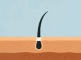 Graft Survival in Hair Transplants