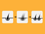 Hair Cloning- Is the Future of Hair Restoration Here