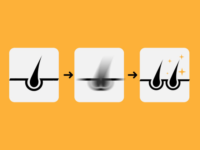 Hair Cloning- Is the Future of Hair Restoration Here