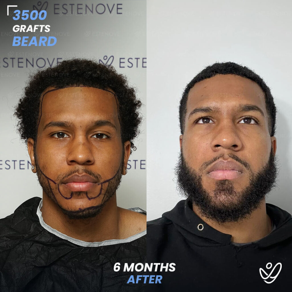Beard transplant - 3500 grafts - 6 months before after Beard transplant - 3500 grafts - 6 months before after