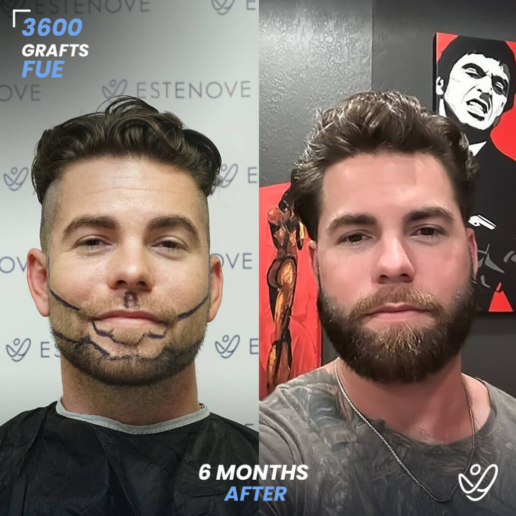 Beard transplant - 3600 grafts - 6 months before after Beard transplant - 3600 grafts - 6 months before after
