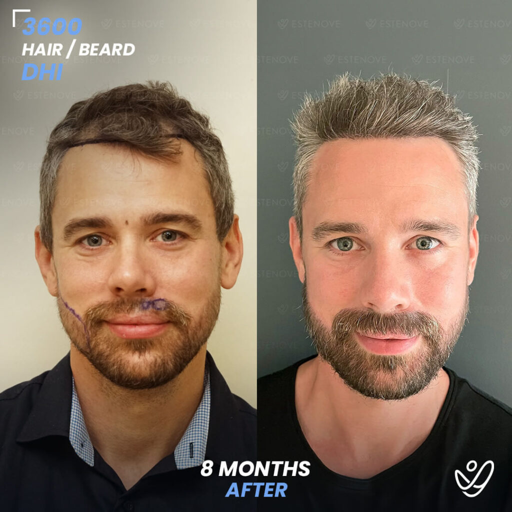 Beard transplant - 3600 grafts - 8 months before after Beard transplant - 3600 grafts - 8 months before after