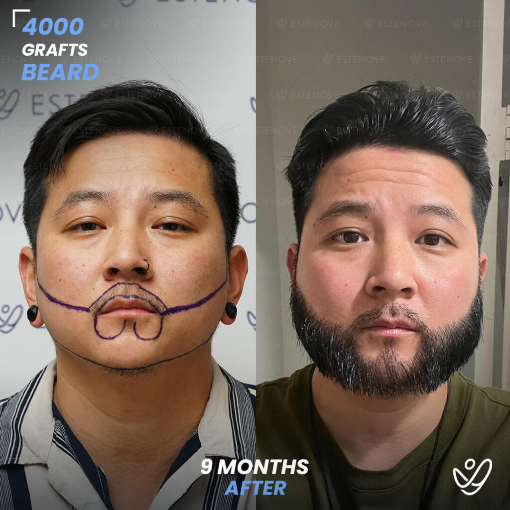 Beard transplant - 4000 grafts - 9 months before after Beard transplant - 4000 grafts - 9 months before after