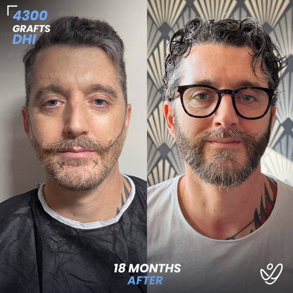 Beard transplant - 4300 grafts - 18 months before after Beard transplant - 4300 grafts - 18 months before after