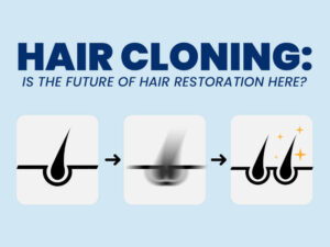 Hair Cloning- Is the Future of Hair Restoration Here
