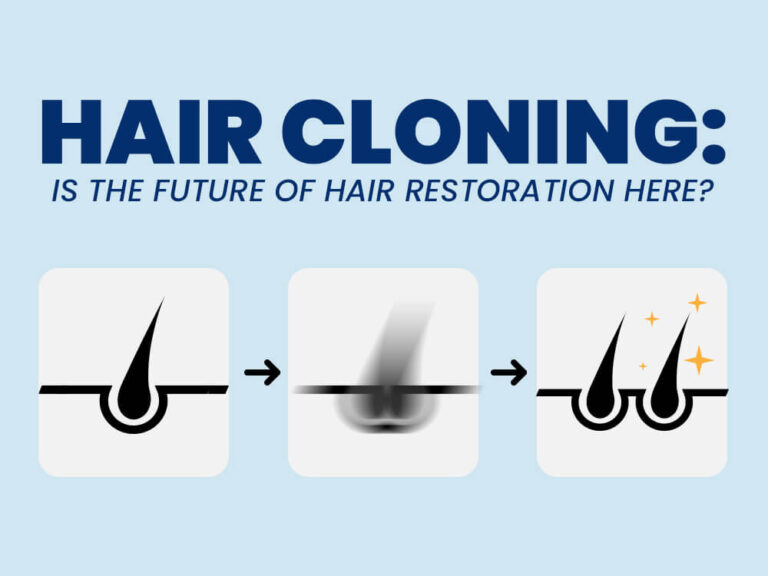 Hair Cloning- Is the Future of Hair Restoration Here