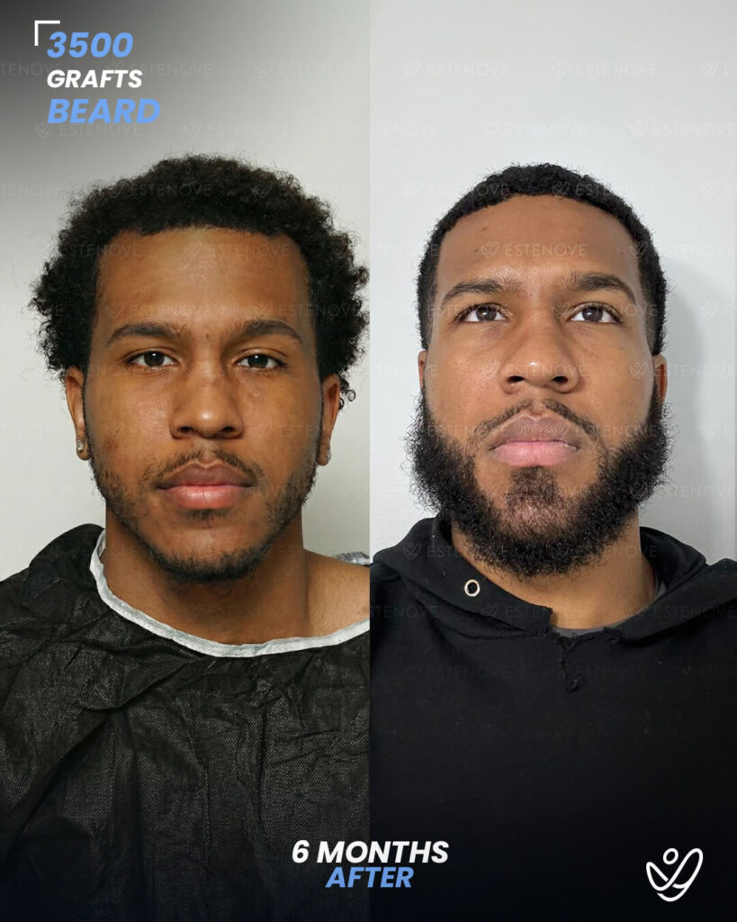 male beard 3500 grafts 6 months after male beard 3500 grafts 6 months after