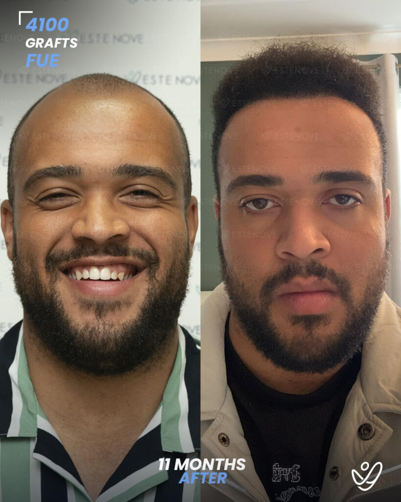 male FUE 4100 grafts 11 months after male FUE 4100 grafts 11 months after