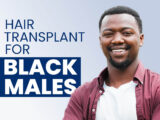 Trasplante capilar para hombres negros