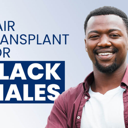Hair Transplant for Black Males