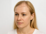 Forehead Hair Transplant in Turkey