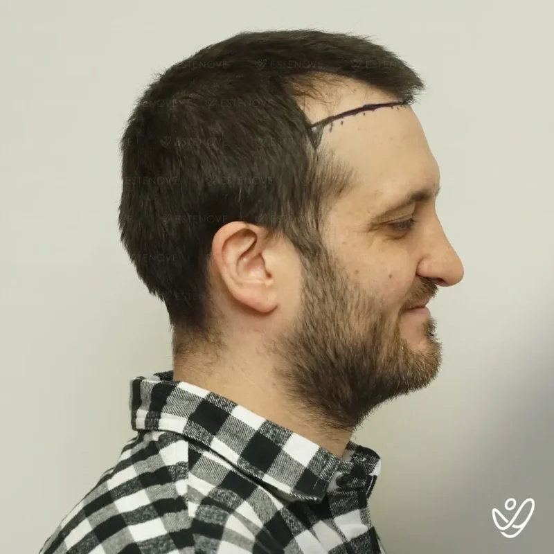 Joey_Intrabartolo-10 (1) before hair transplant procedure