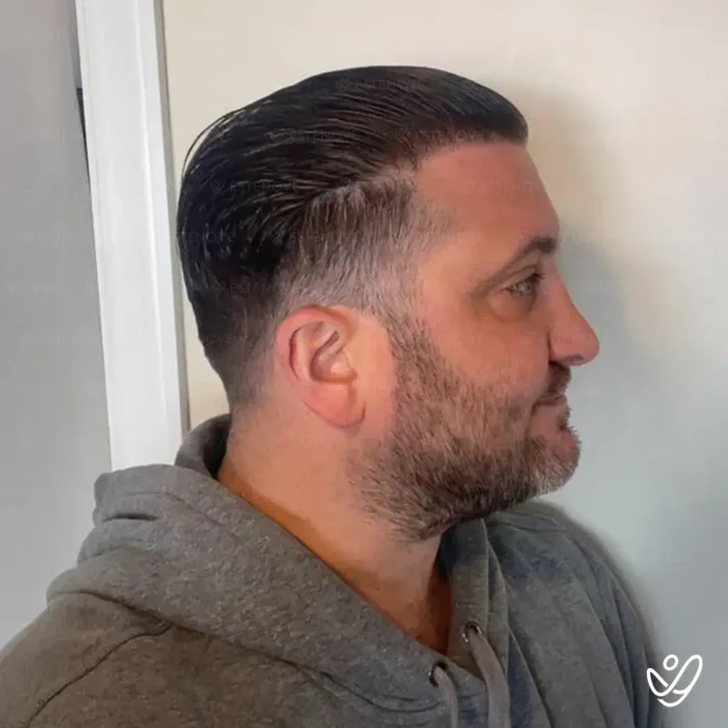 Joey_Intrabartolo-11 (1) After hair transplant procedure