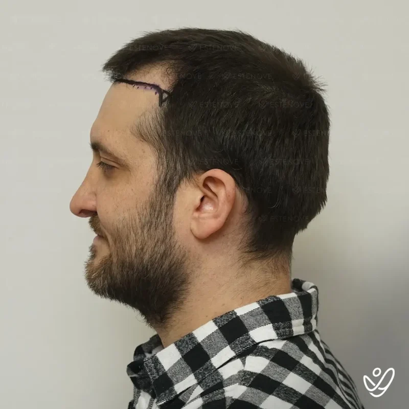 Joey_Intrabartolo-12 (1) before hair transplant