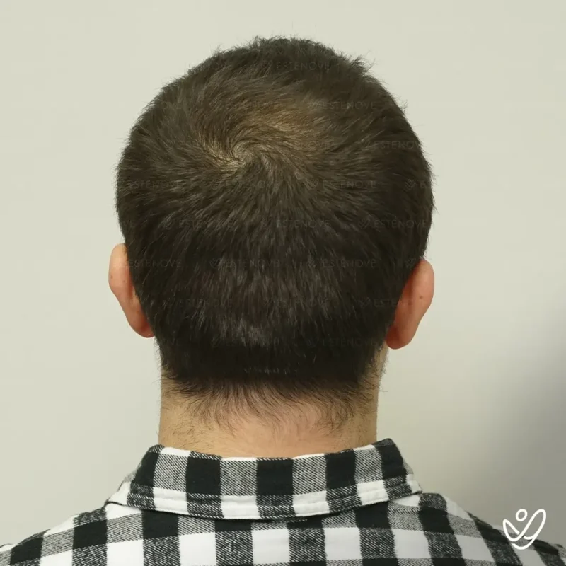 Joey_Intrabartolo-14_1 (1) before hair transplant surgeon