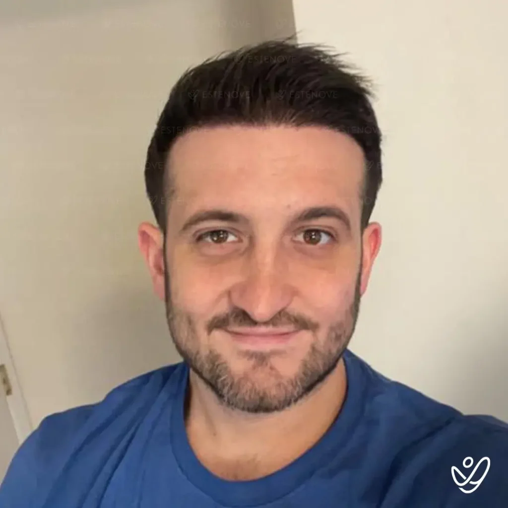 After hair transplantation