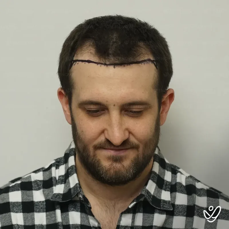 Joey_Intrabartolo-8A (1) before hair transplantation