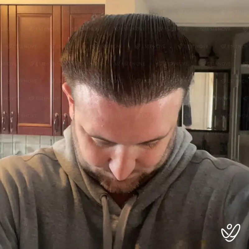 Joey_Intrabartolo-8B (1) After hair transplant surgeon