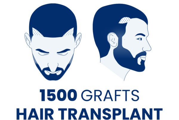 1500 Grafts Hair Transplant