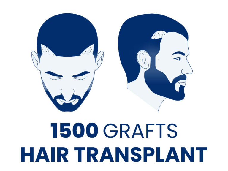 1500 Grafts Hair Transplant