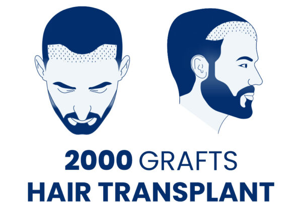 2000 Grafts Hair Transplant