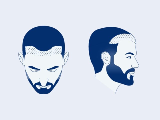 2000 Grafts Hair Transplant