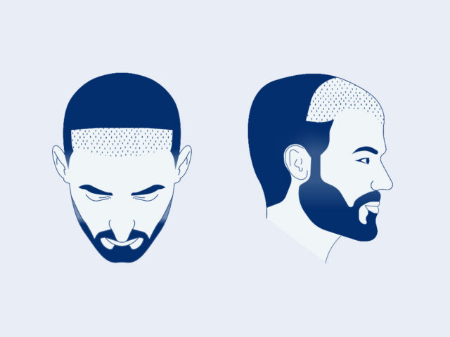 4000 Grafts Hair Transplant