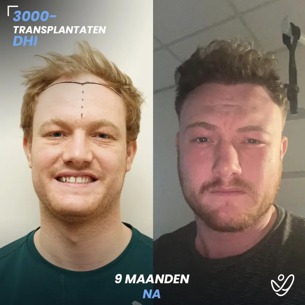 B_A-POST_Template_DU-B_A5_1 (1) 3000 Transplantaten DHI 9 Maaanden Na