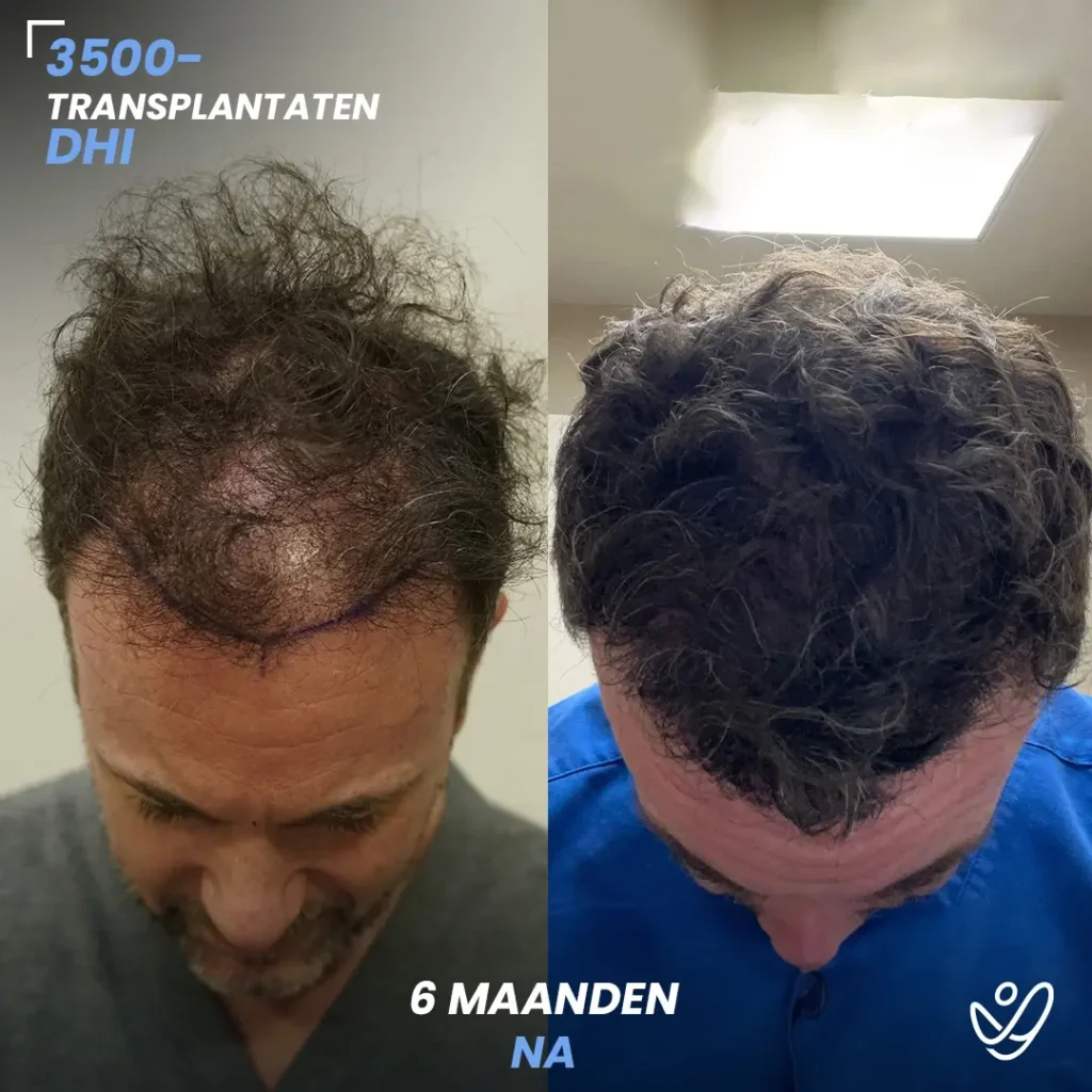 B_A-POST_Template_DU-B_A6_1 (1) 3500 Transplantaten DHI 6 Maaanden Na