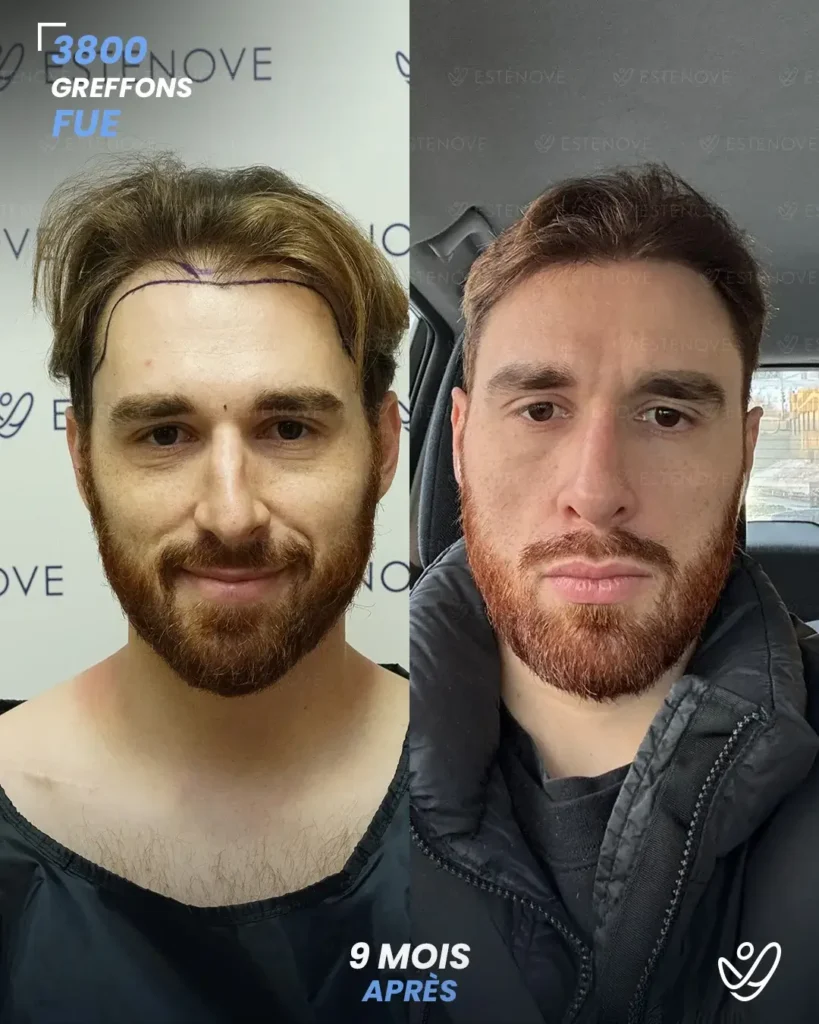 DAVIDE ASSELIN Greffe de Cheveux FUE 3800 greffons 9 mois apres