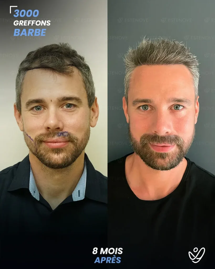 ROBİN MİKAEL LARSSON Greffe de barbe 3000 greffons 8 mois apres