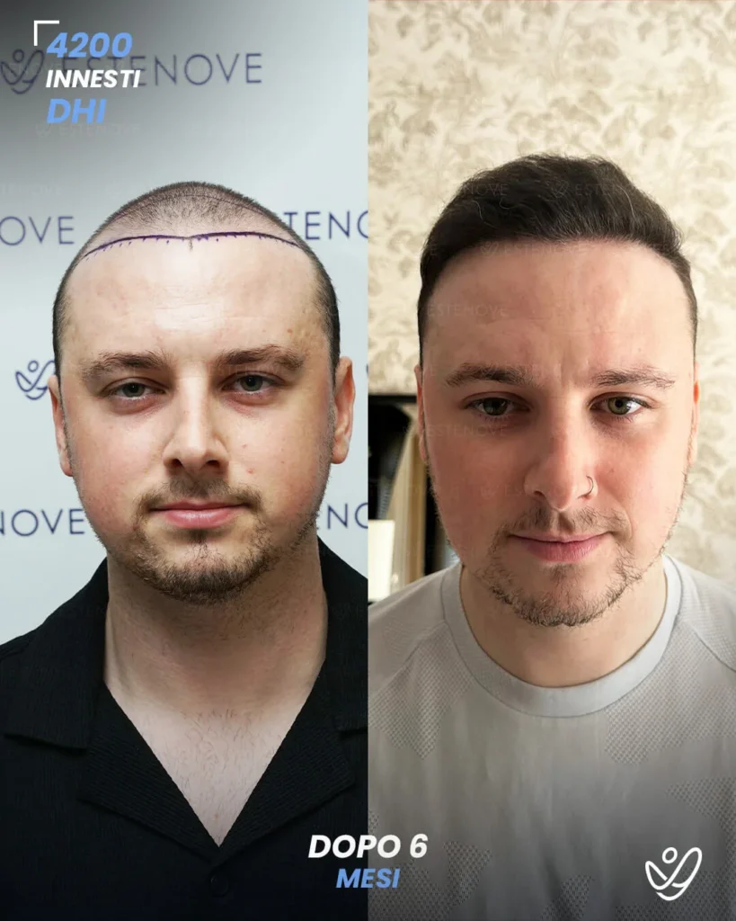 20 maschile DHI 4200 innesti 6 mesi prima e dopo