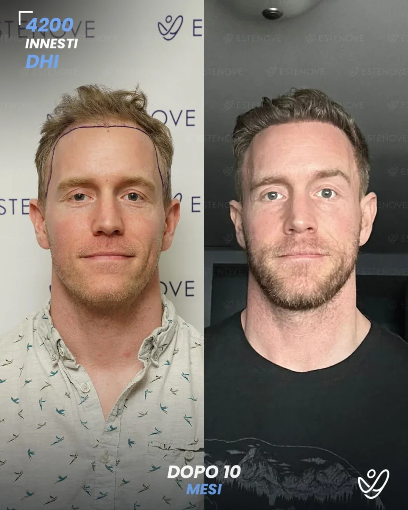 22 maschile DHI 4200 innesti 10 mesi prima e dopo