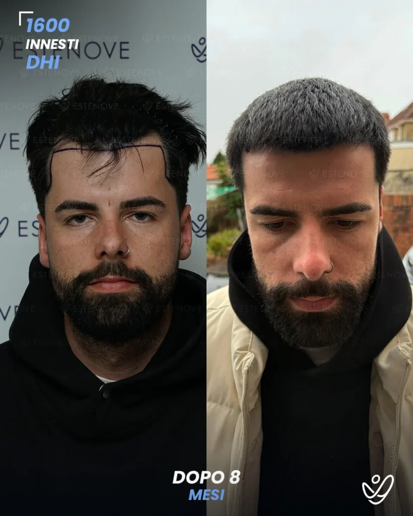 24 maschile DHI 1600 innesti 8 mesi prima e dopo
