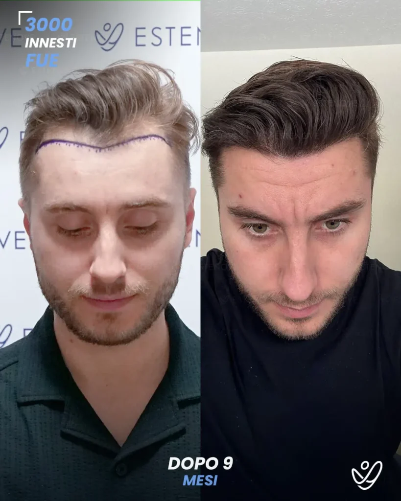 26 maschile FUE 3000 innesti 6 mesi prima e dopo