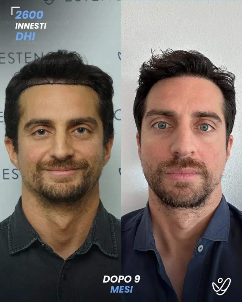 4 maschile FUE 2600 innesti 9 mesi prima e dopo