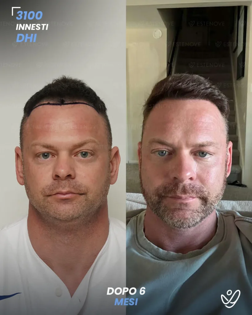 5 maschile DHI 3100 innesti 6 mesi prima e dopo