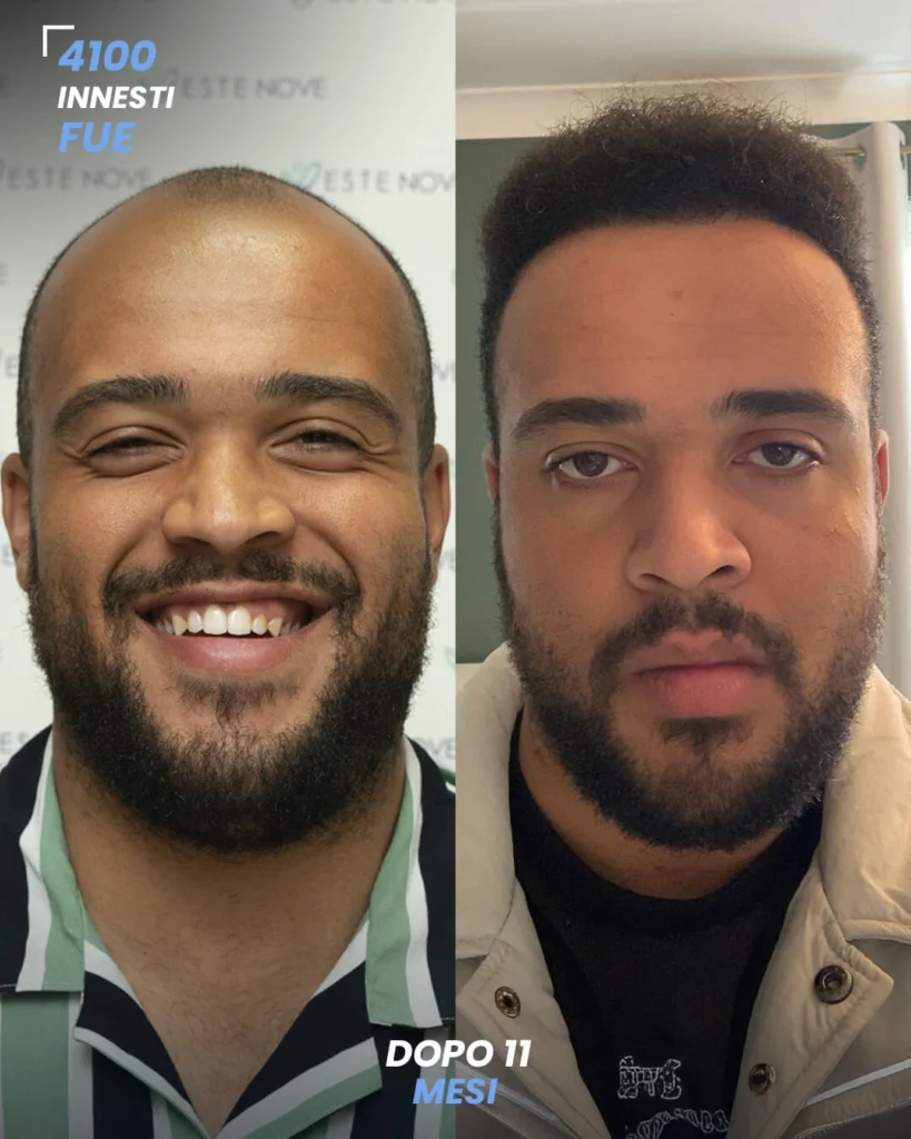 1 maschile FUE 4100 innesti 11 mesi prima e dopo