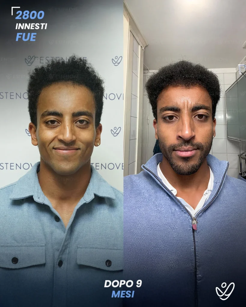 2 maschile FUE 2800 innesti 9 mesi prima e dopo