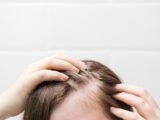 Finasteride side effects in women