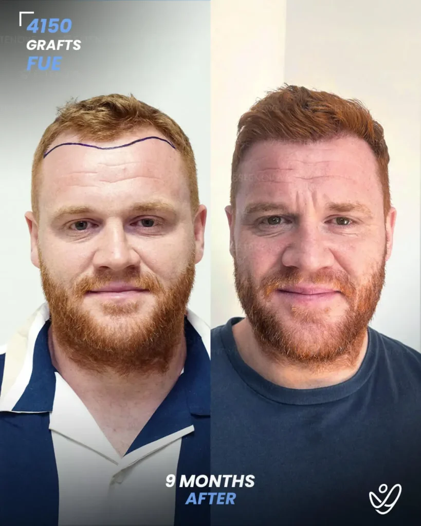 FUE Hair Transplant 4150 Grafts 9 Months Before&After FUE Hair Transplant 4150 Grafts 9 Months Before&After