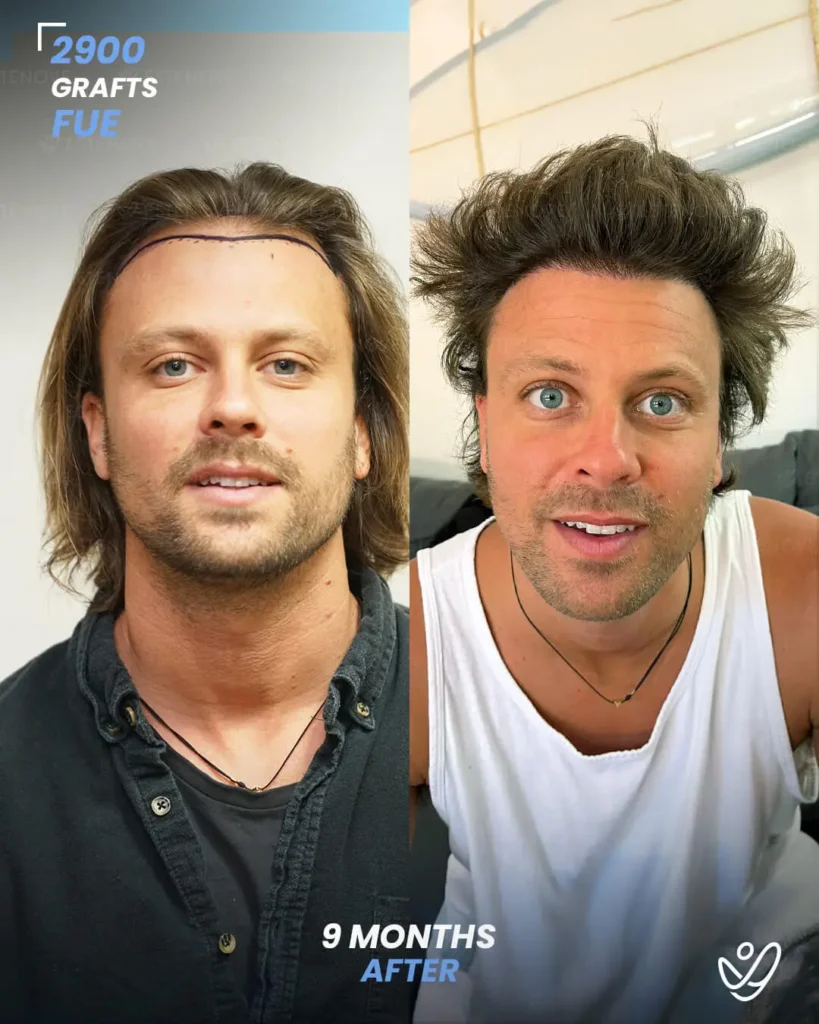FUE Hair Transplant 2900 Grafts 9 Months Before&After FUE Hair Transplant 2900 Grafts 9 Months Before&After