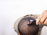 derma roller for hair growth