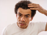 does ozempic cause hair loss