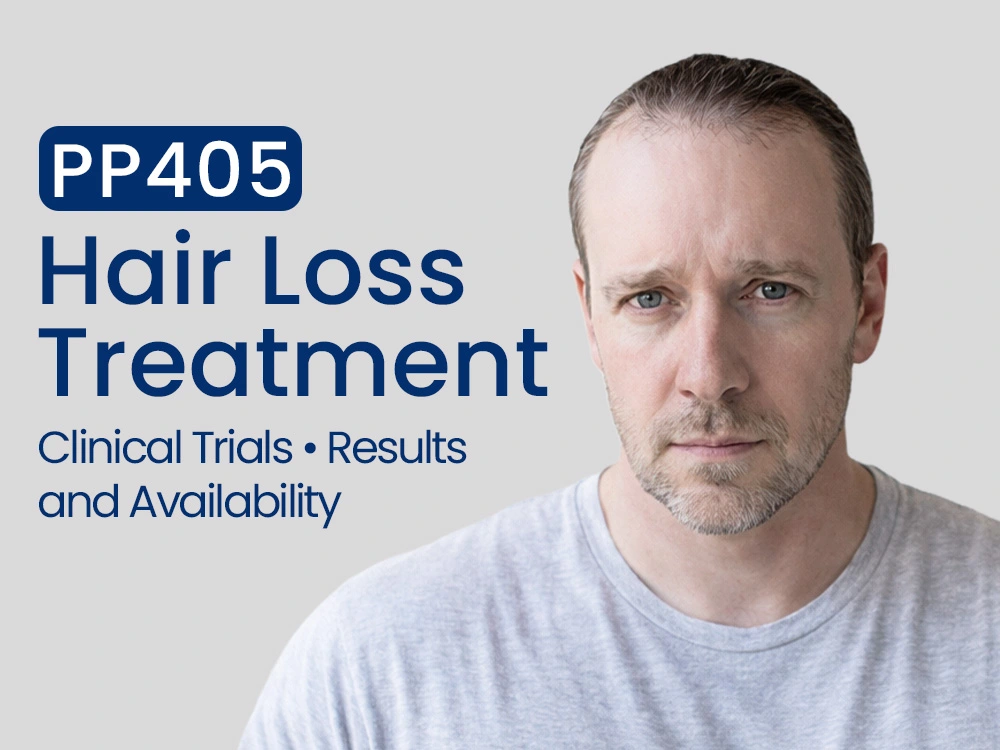 Man with a receding hairline featuring text about PP405 hair loss treatment clinical trials, results, and availability.